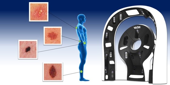 Skin Cancer Detection (Kaggle ISIC 2024)